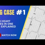 ECG Case 1: Two Heart Rates in a Healthy Man