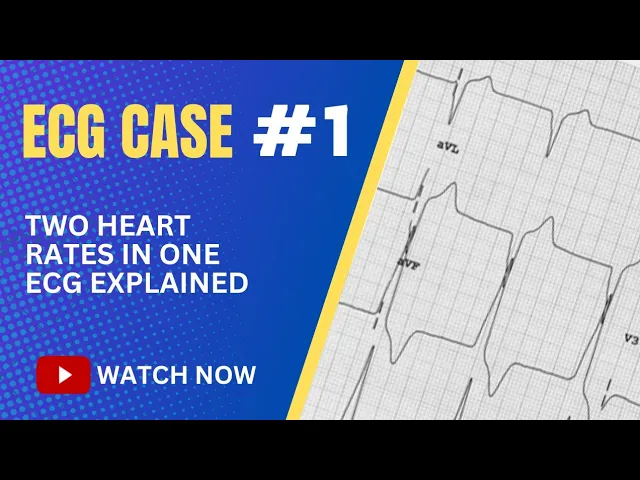 ECG Case