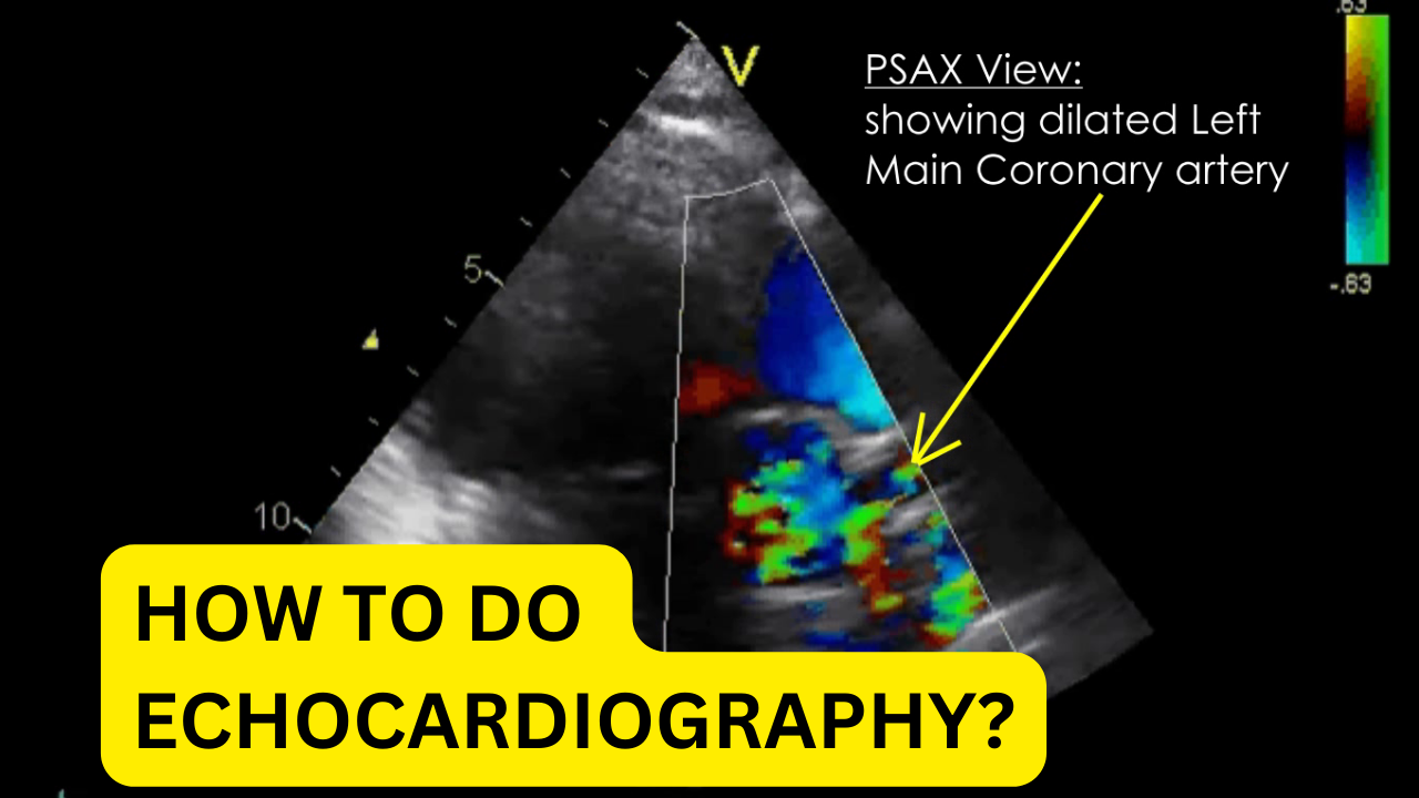 How to do Echocardiography