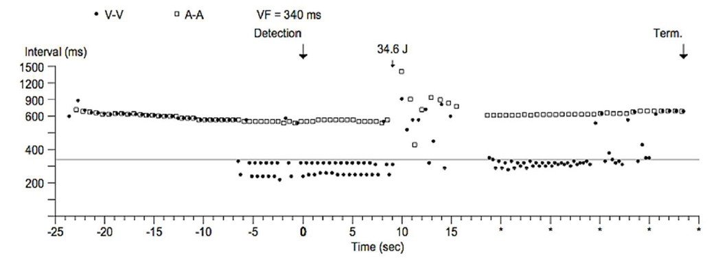 "train track" appearance on cardiac CEID (Cardiac Electronic Implantable Device) tracings