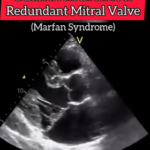 When to intervene for dilated Aortic Root in Marfan Syndrome